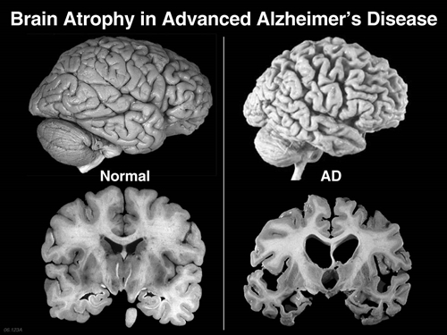 Alzheimer picture