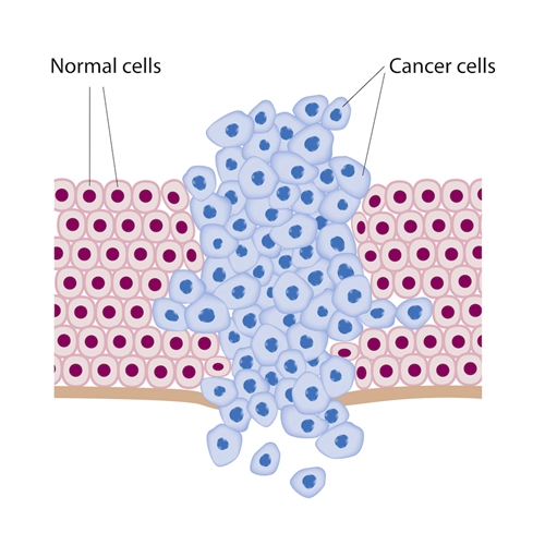 Cancer cell picture
