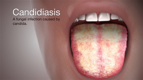 Candidiasis picture
