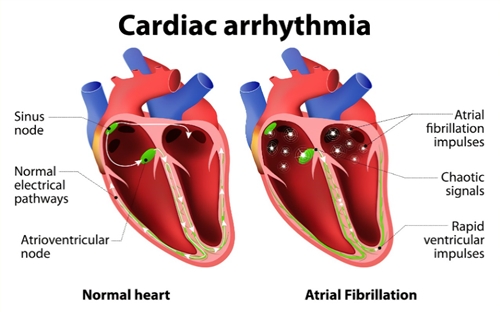 Cardiac arrhythmia picture