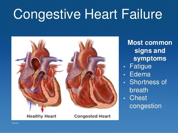 Congestive heart failure picture