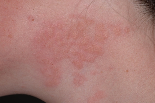 Eczema picture