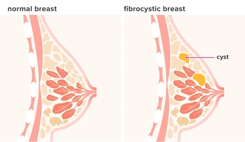 Fibrocystic breast picture
