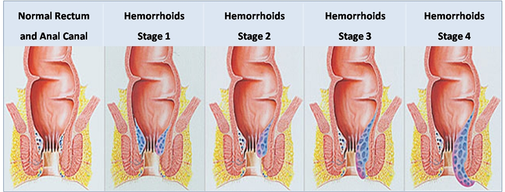 Hemorrhoids picture