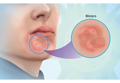Herpes picture