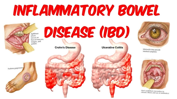 IBD picture