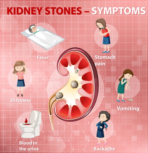 Kidney stones picture
