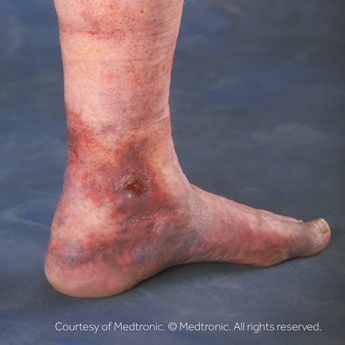 Leg ulcer picture