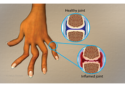 Rheumatoid arthritis picture
