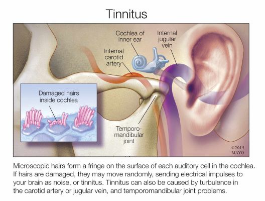 Tinnitus picture