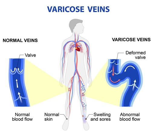 Varicose veins picture