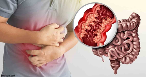 Crohn's disease picture