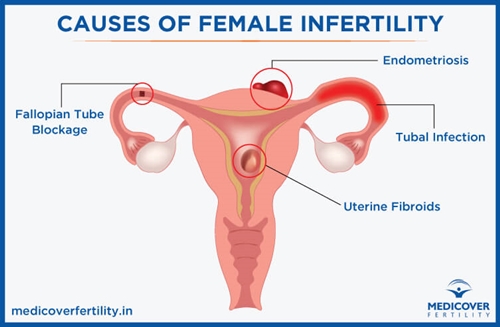 Female infertility picture