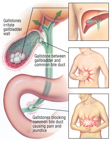 Gallstones picture