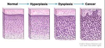 Hyperplasia picture