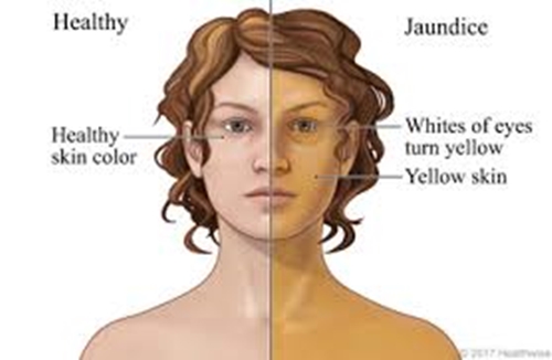 Jaundice picture