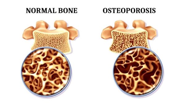 Osteoporosis picture