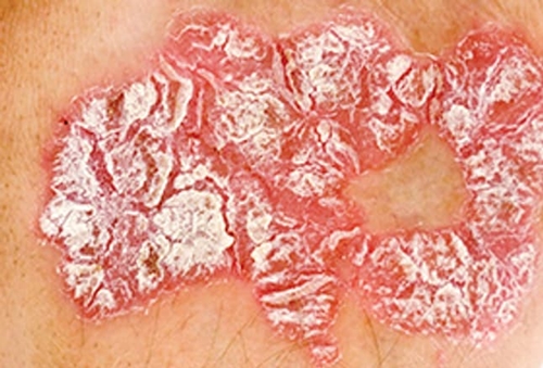 Psoriasis picture