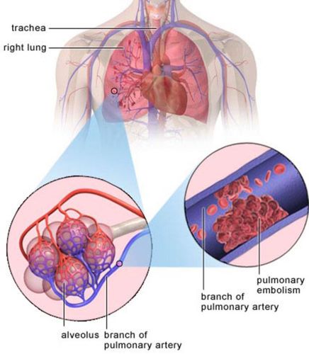 Deep thromboses picture