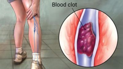 Thromboses picture