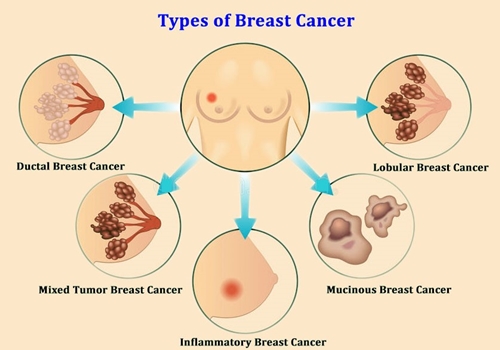 Types of breast cancer picture