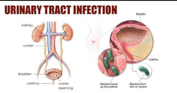 Urinary track picture